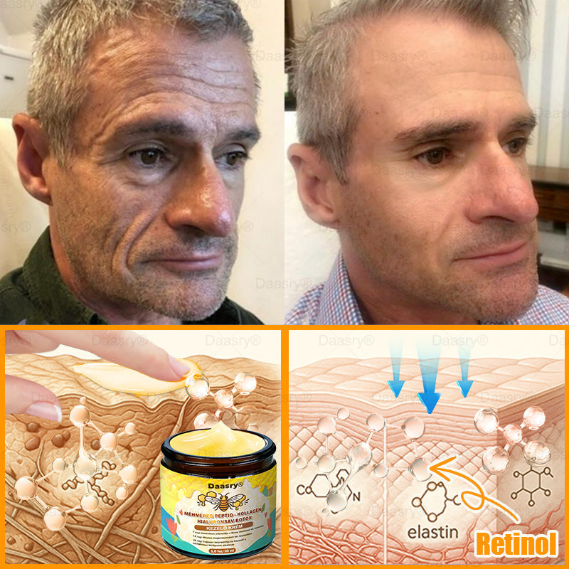 Világszerte legkelendőbb termékek-Daasry® Méhméreg Kezelő Krém, méhméreg peptidekkel, botulinum toxinnal, hialuronsavval és kollagénnel💧. Hatékonyan küzd a ráncok, finom vonalak, megereszkedés, terhességi csíkok és sötét foltok ellen !